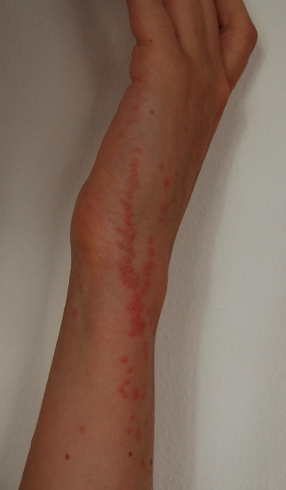 Bed bug bites on the outside of the forearm and wrist: many small red bumps in lines and clusters, about four days old