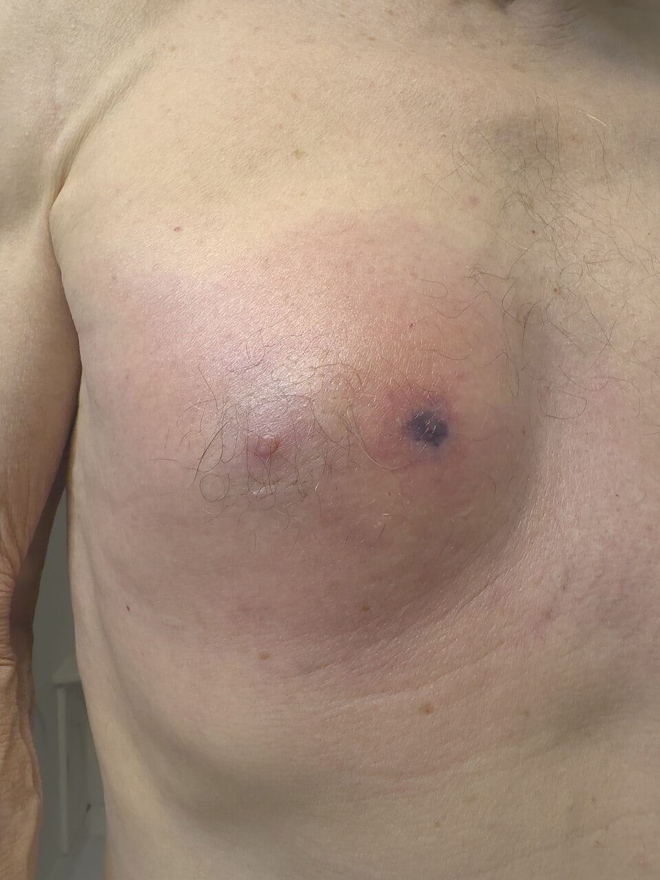 A brown recluse spider bite two days after the bite: a swollen red area with a small dark centre
