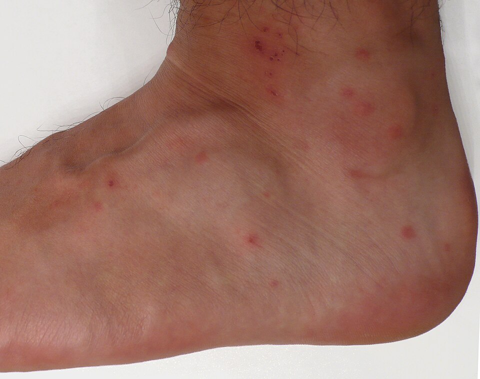 Chigger bites on the side of the foot and ankle: many small red bumps clustered where socks and shoes sit