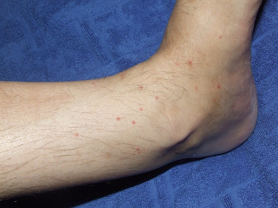 Flea bites on the lower leg and ankle: scattered tiny red dots