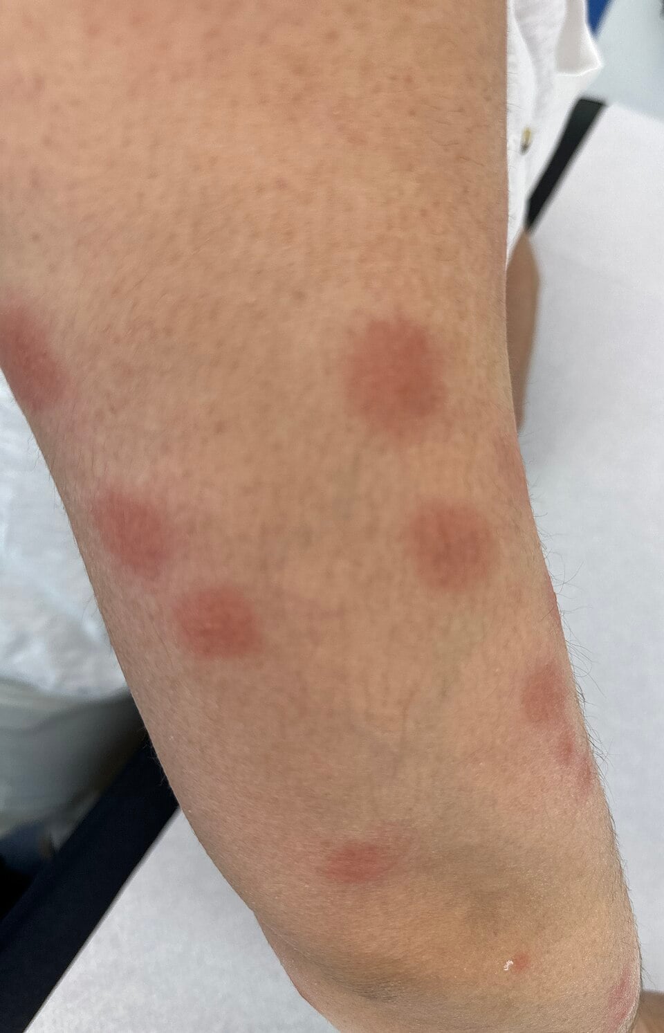 Several round red insect bites spaced out across the skin in a rough line