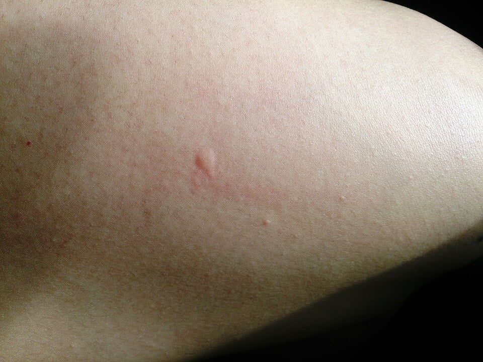 A typical mosquito bite on the thigh: a small raised pale welt with slight redness around it
