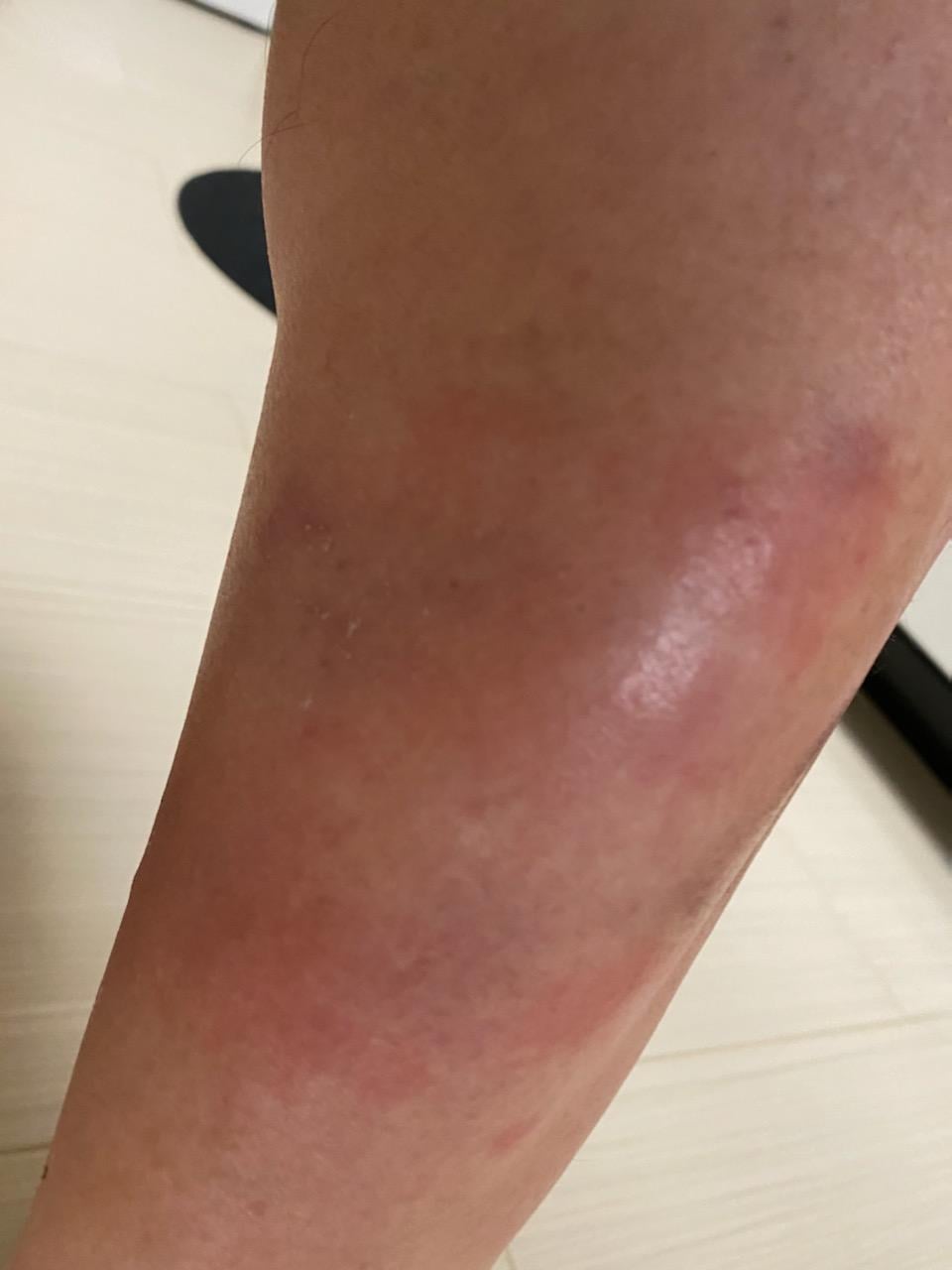 A large red swollen patch on the lower leg from a strong allergic reaction to mosquito bites (skeeter syndrome)