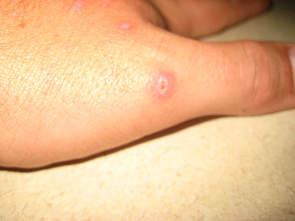 A spider bite on the back of a hand — a raised red welt with a central blistered point