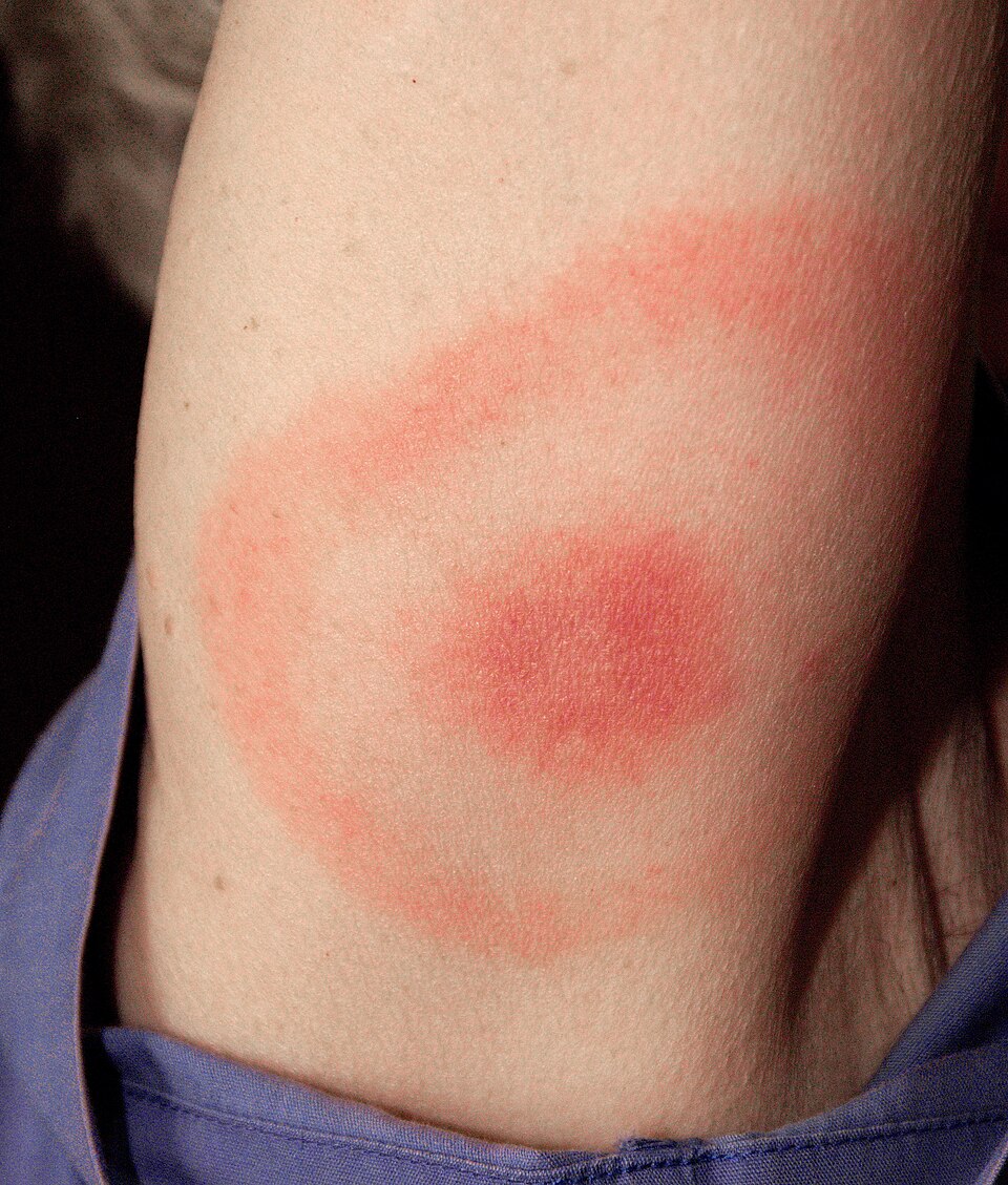 A bullseye rash (erythema migrans) on the back of an upper arm: a red centre surrounded by a clear ring and an outer red ring